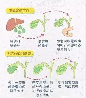 如何预防胆囊结石，掌握这三级预防就够了！